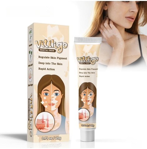 Vitiligo Removal Cream In Pakistan